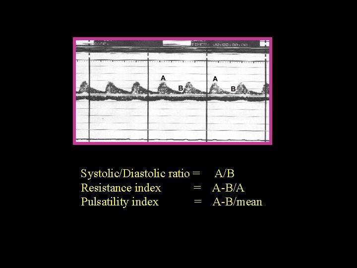 Systolic/Diastolic ratio = A/B Resistance index = A-B/A Pulsatility index = A-B/mean 