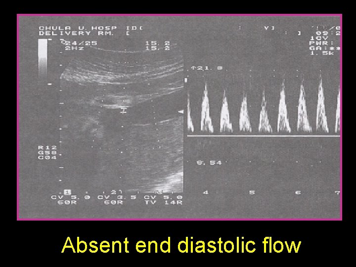 Absent end diastolic flow 