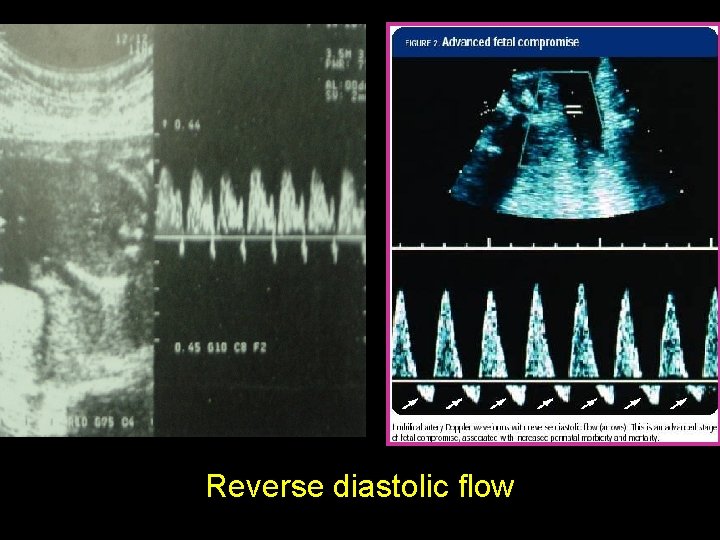 Reverse diastolic flow 