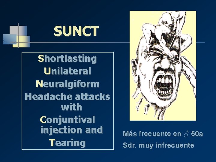 SUNCT Shortlasting Unilateral Neuralgiform Headache attacks with Conjuntival injection and Tearing Más frecuente en SUNCT Shortlasting Unilateral Neuralgiform Headache attacks with Conjuntival injection and Tearing Más frecuente en