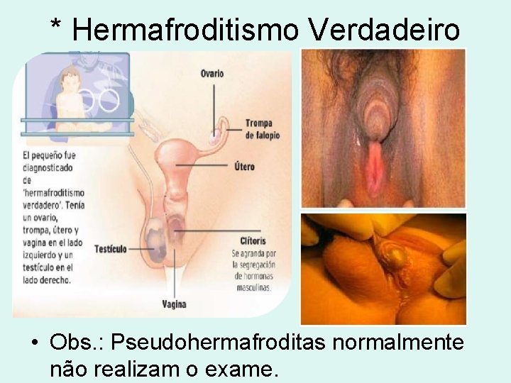 * Hermafroditismo Verdadeiro • Obs. : Pseudohermafroditas normalmente não realizam o exame. 