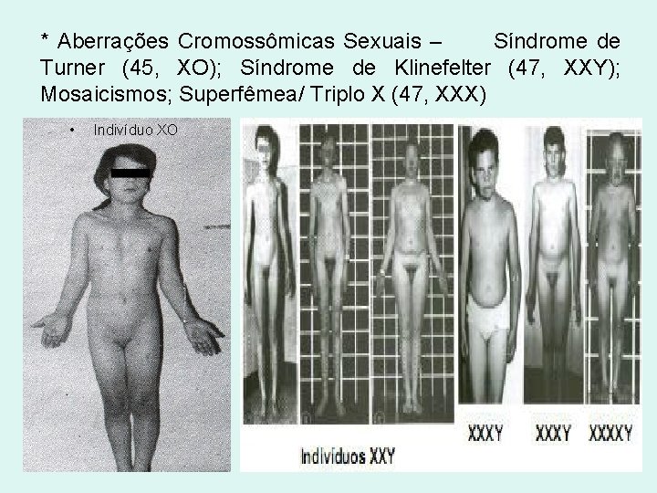 * Aberrações Cromossômicas Sexuais – Síndrome de Turner (45, XO); Síndrome de Klinefelter (47,