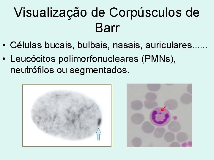 Visualização de Corpúsculos de Barr • Células bucais, bulbais, nasais, auriculares. . . •