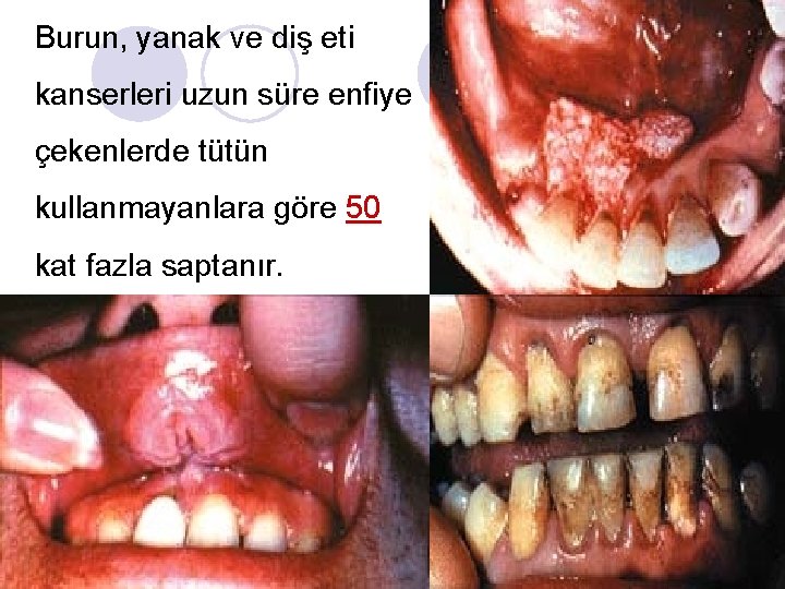Burun, yanak ve diş eti kanserleri uzun süre enfiye çekenlerde tütün kullanmayanlara göre 50