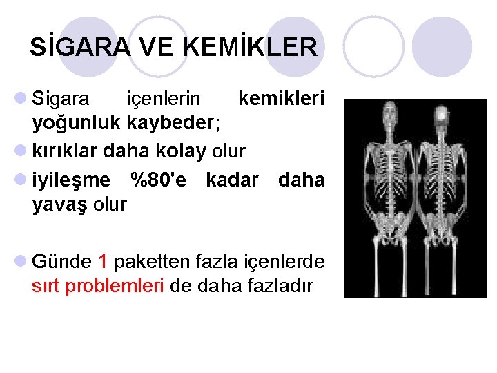 SİGARA VE KEMİKLER l Sigara içenlerin kemikleri yoğunluk kaybeder; l kırıklar daha kolay olur