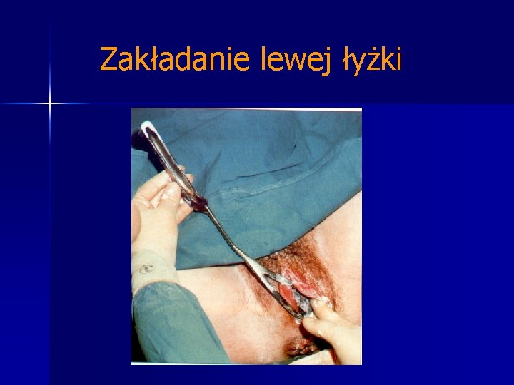 Zakładanie lewej łyżki Zakładanie lewej łyżki