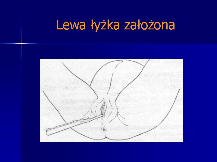 Lewa łyżka założona 