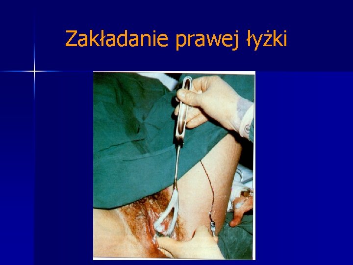 Zakładanie prawej łyżki 