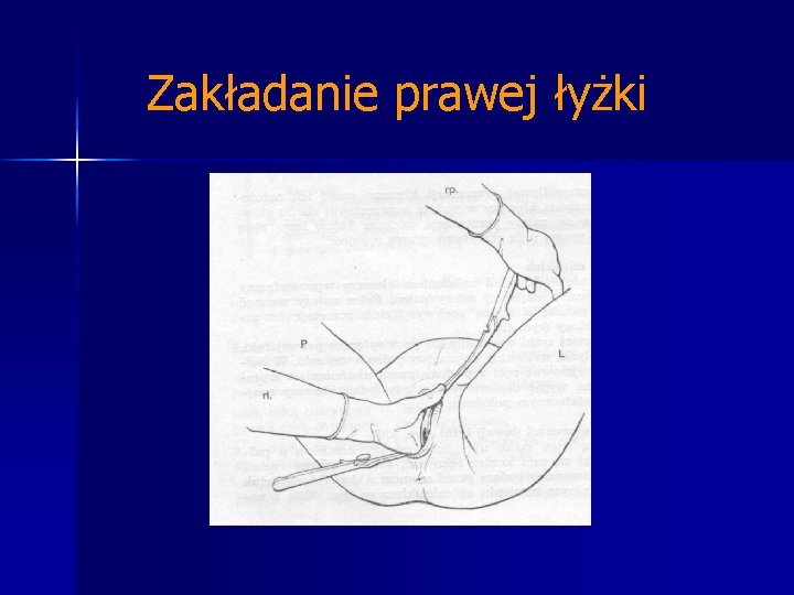 Zakładanie prawej łyżki 