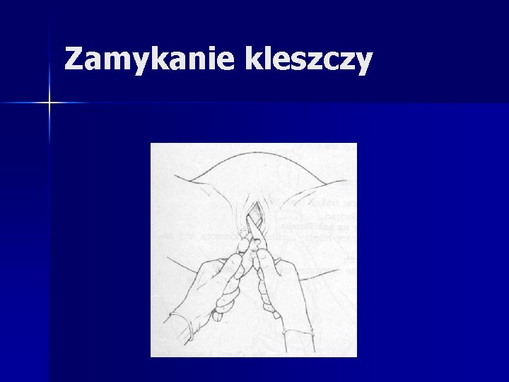 Zamykanie kleszczy Zamykanie kleszczy