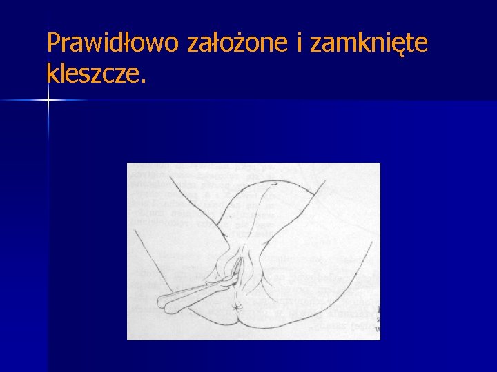 Prawidłowo założone i zamknięte kleszcze. Prawidłowo założone i zamknięte kleszcze.
