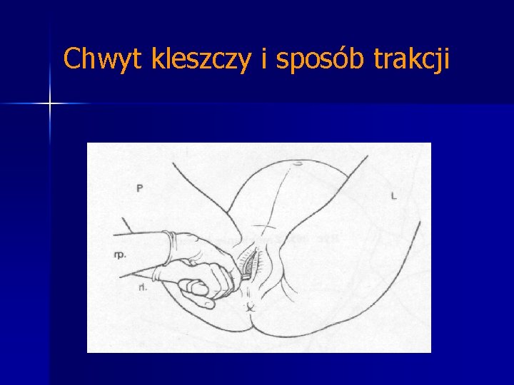 Chwyt kleszczy i sposób trakcji 