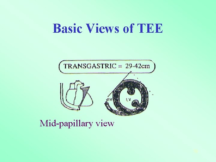 Basic Views of TEE Mid-papillary view 78 
