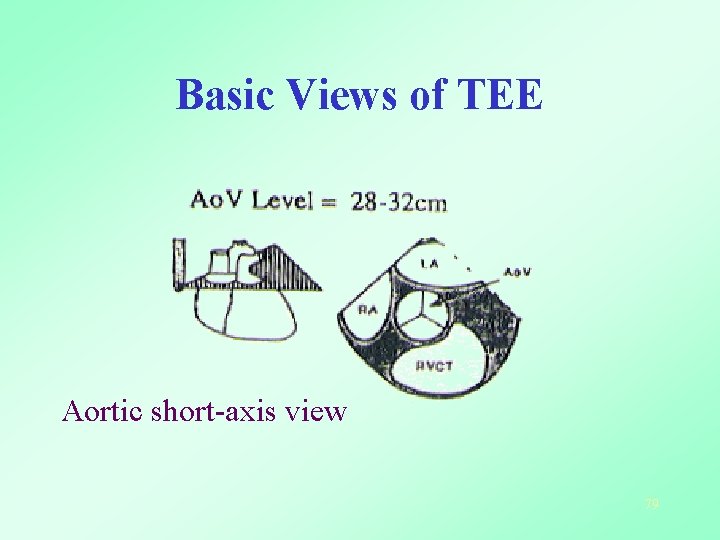 Basic Views of TEE Aortic short-axis view 79 