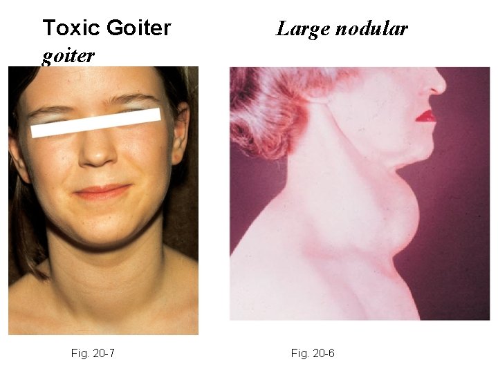 Toxic Goiter goiter Fig. 20 -7 Large nodular Fig. 20 -6 