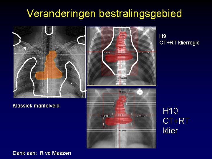 Veranderingen bestralingsgebied H 9 CT+RT klierregio Klassiek mantelveld Dank aan: R vd Maazen H