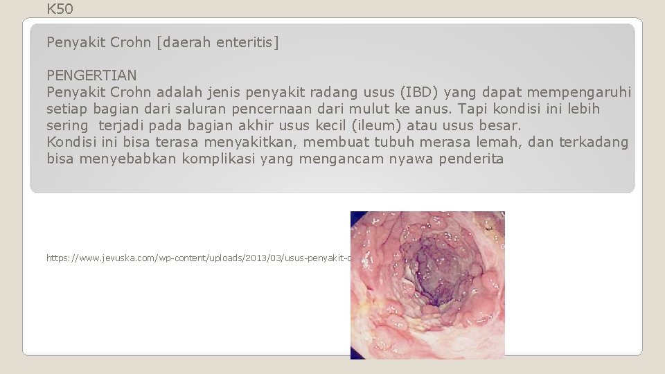 K 50 Penyakit Crohn [daerah enteritis] PENGERTIAN Penyakit Crohn adalah jenis penyakit radang usus