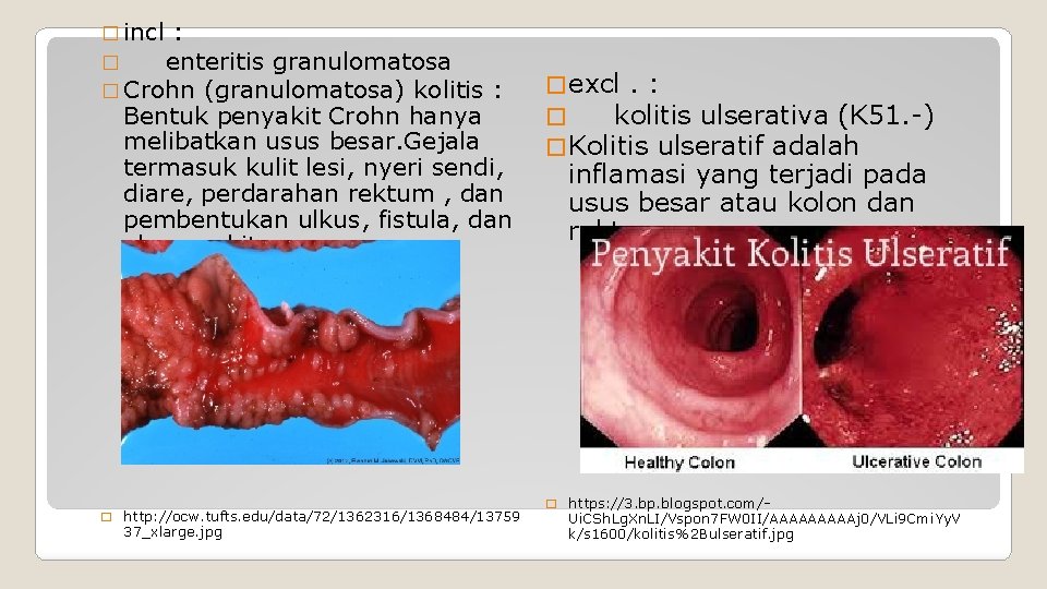 � incl : � enteritis granulomatosa � Crohn (granulomatosa) kolitis : Bentuk penyakit Crohn