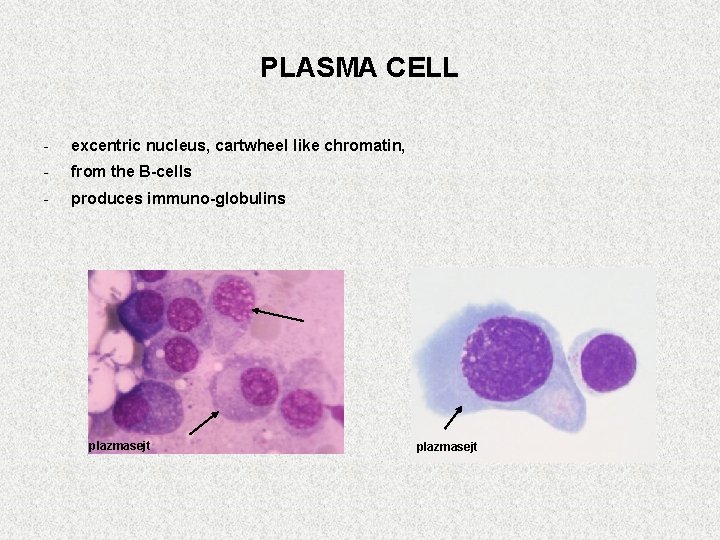 PLASMA CELL - excentric nucleus, cartwheel like chromatin, - from the B-cells - produces