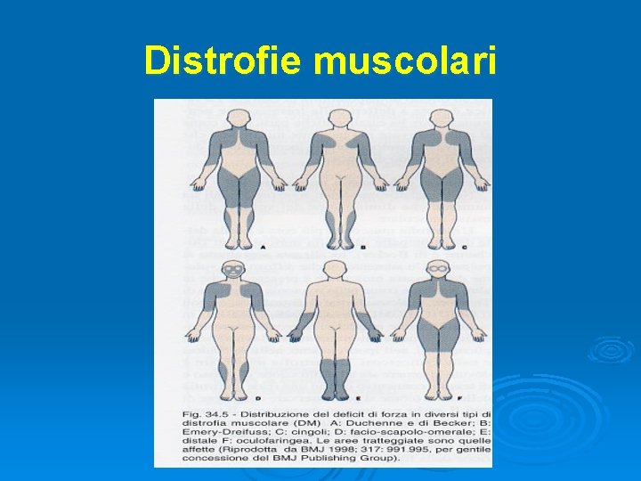 Distrofie muscolari 