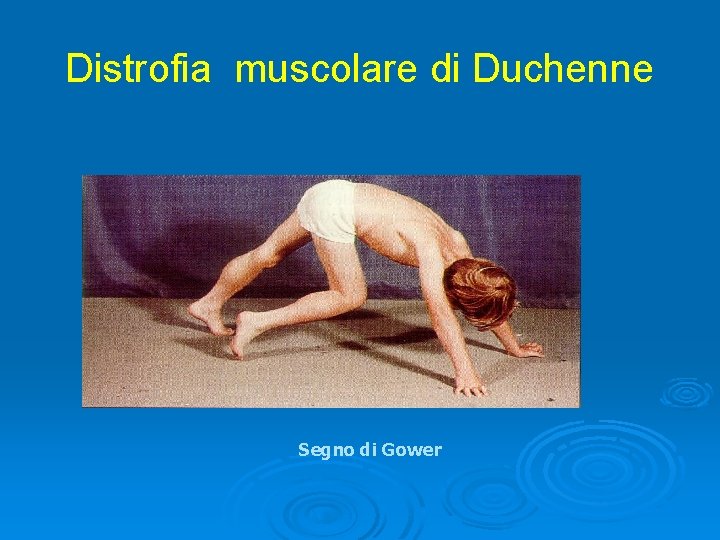 Distrofia muscolare di Duchenne Segno di Gower 