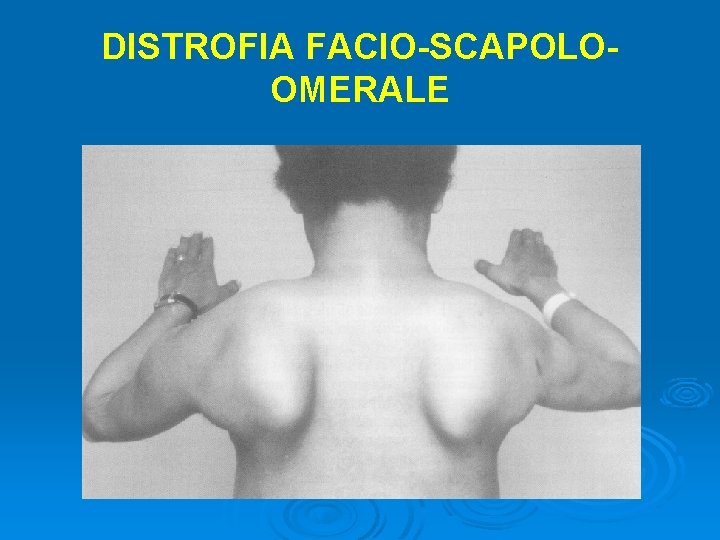 DISTROFIA FACIO-SCAPOLOOMERALE 