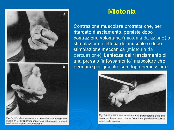 Miotonia Contrazione muscolare protratta che, per ritardato rilasciamento, persiste dopo contrazione volontaria (miotonia da