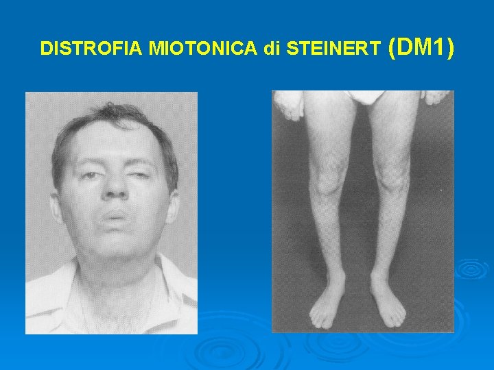 DISTROFIA MIOTONICA di STEINERT (DM 1) 