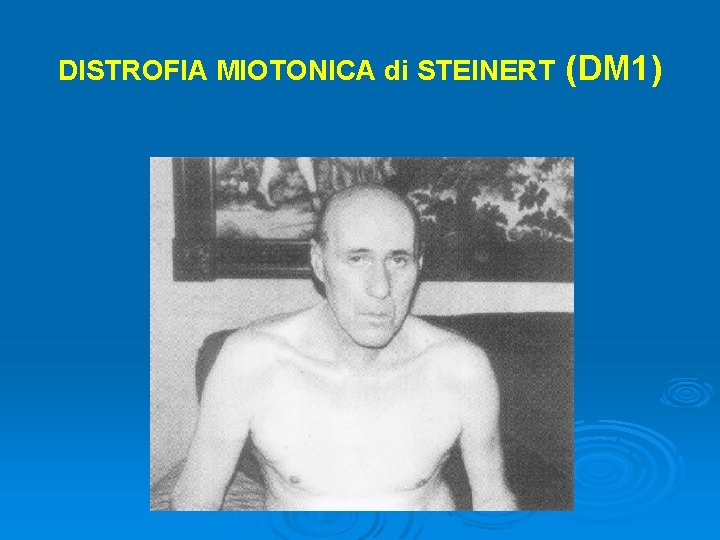 DISTROFIA MIOTONICA di STEINERT (DM 1) 