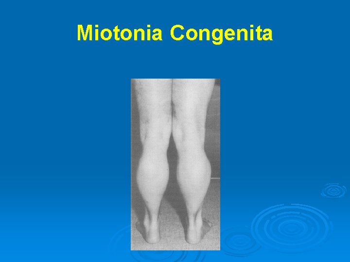 Miotonia Congenita 