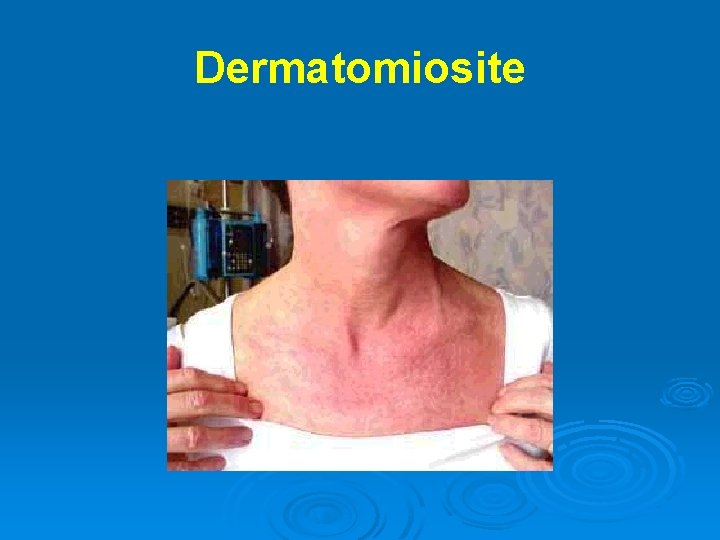 Dermatomiosite 