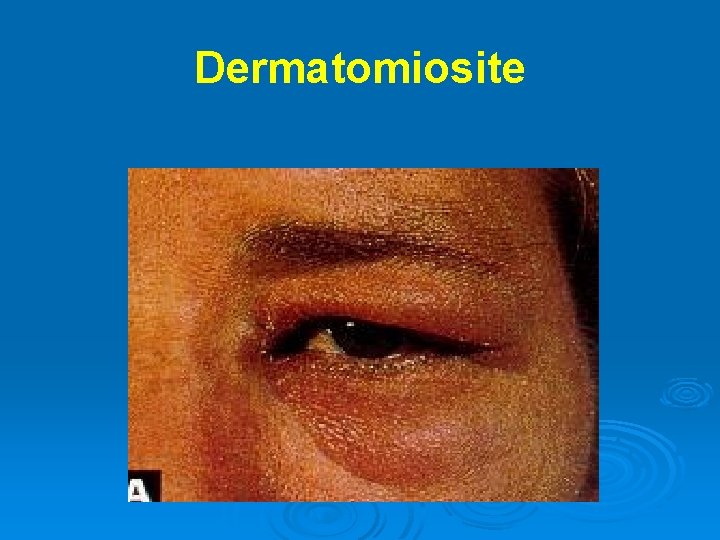 Dermatomiosite 
