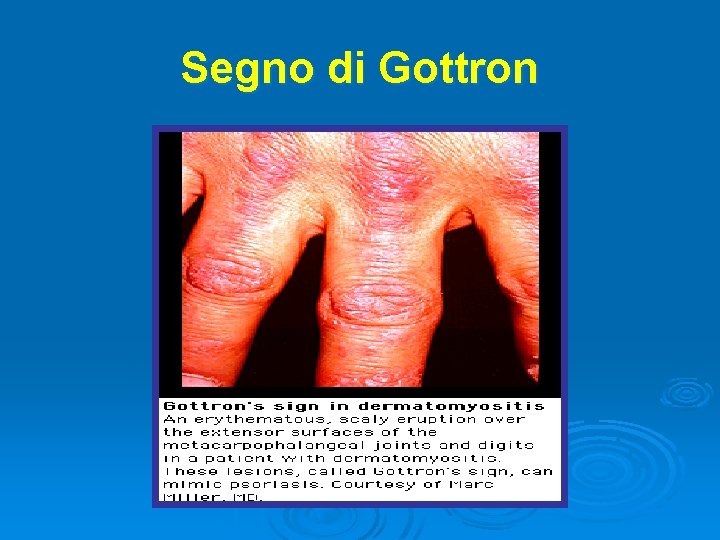 Segno di Gottron 