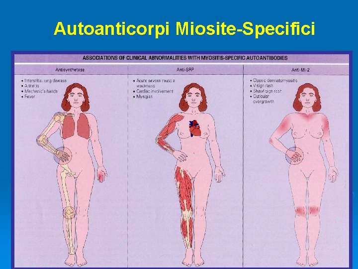 Autoanticorpi Miosite-Specifici 