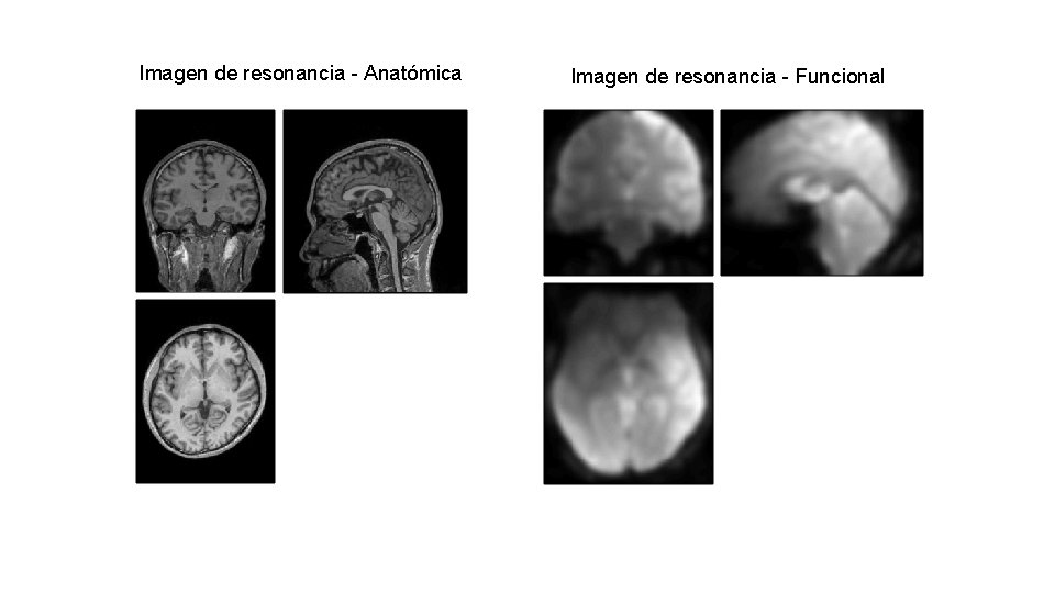 Imagen de resonancia - Anatómica Imagen de resonancia - Funcional 