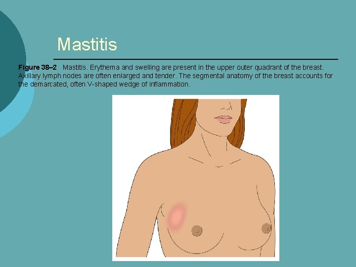 Mastitis Figure 38– 2 Mastitis. Erythema and swelling are present in the upper outer