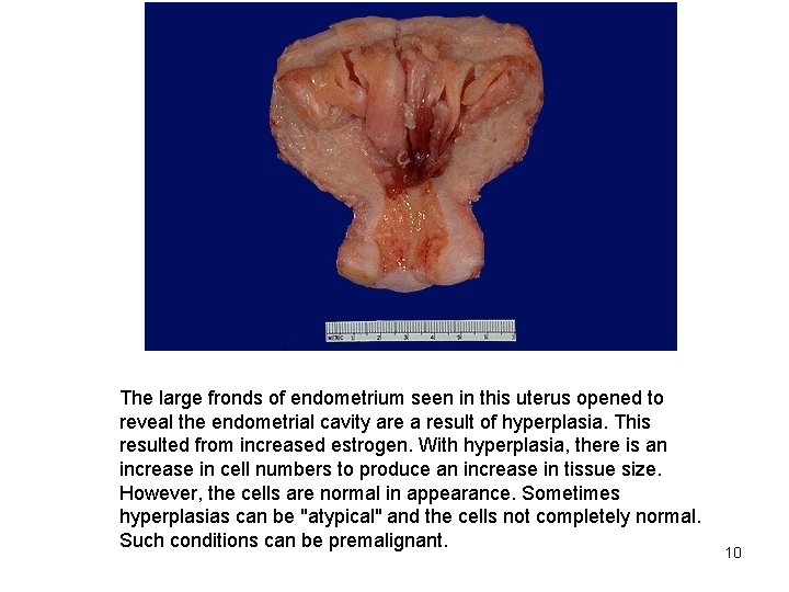 The large fronds of endometrium seen in this uterus opened to reveal the endometrial