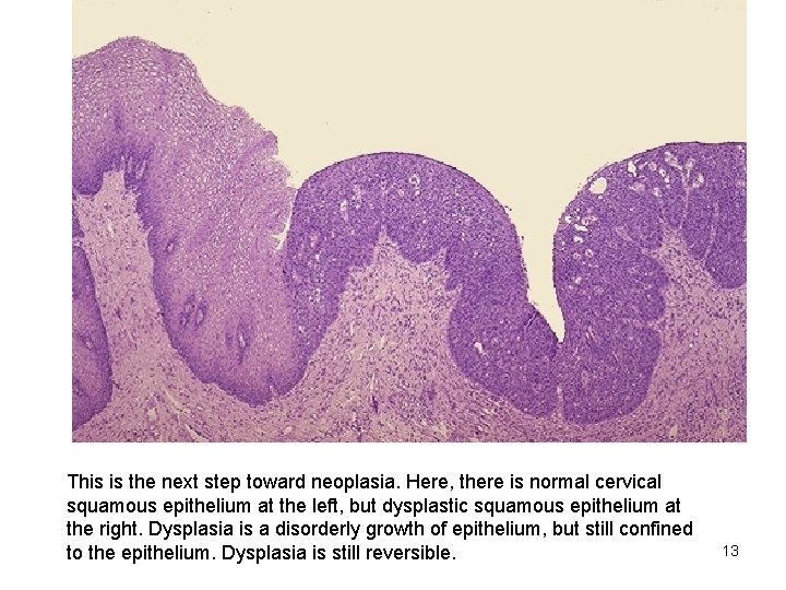 This is the next step toward neoplasia. Here, there is normal cervical squamous epithelium