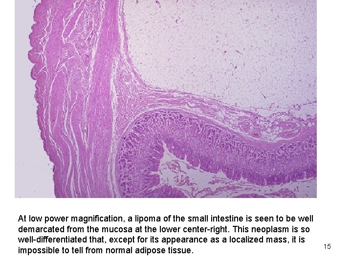 At low power magnification, a lipoma of the small intestine is seen to be