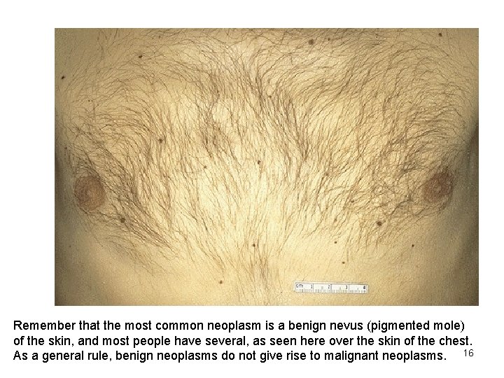 Remember that the most common neoplasm is a benign nevus (pigmented mole) of the