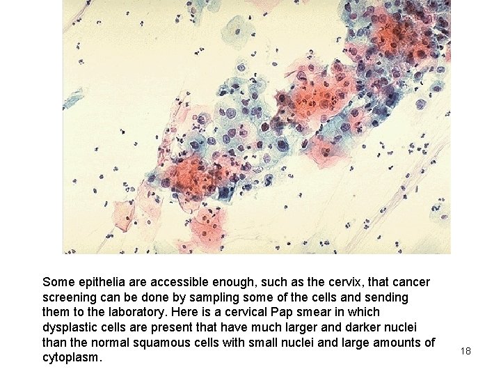Some epithelia are accessible enough, such as the cervix, that cancer screening can be
