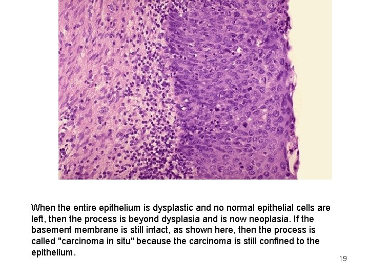 When the entire epithelium is dysplastic and no normal epithelial cells are left, then