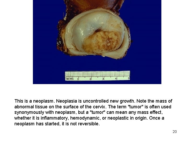 This is a neoplasm. Neoplasia is uncontrolled new growth. Note the mass of abnormal