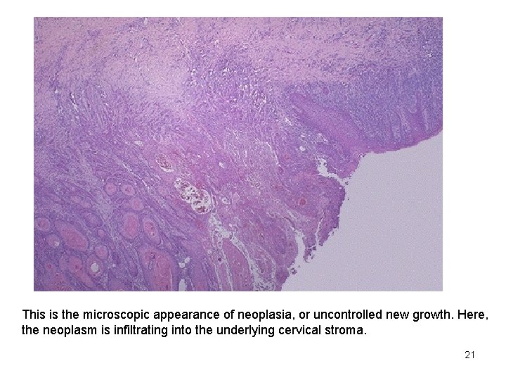 This is the microscopic appearance of neoplasia, or uncontrolled new growth. Here, the neoplasm