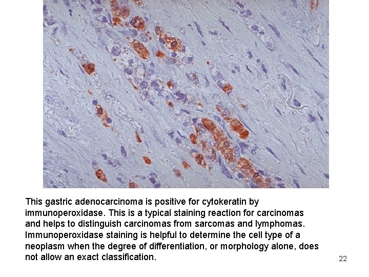 This gastric adenocarcinoma is positive for cytokeratin by immunoperoxidase. This is a typical staining