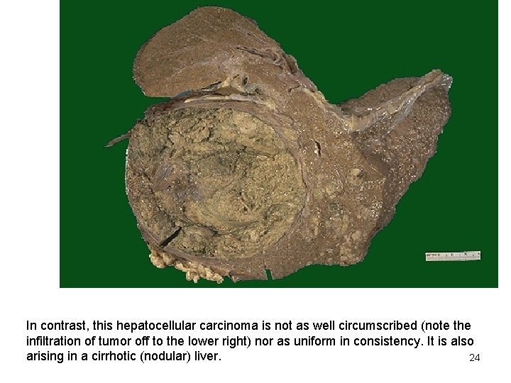 In contrast, this hepatocellular carcinoma is not as well circumscribed (note the infiltration of