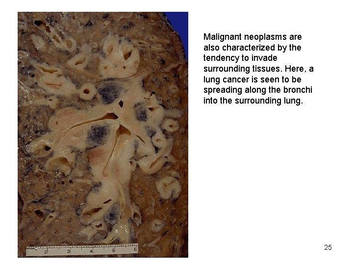 Malignant neoplasms are also characterized by the tendency to invade surrounding tissues. Here, a