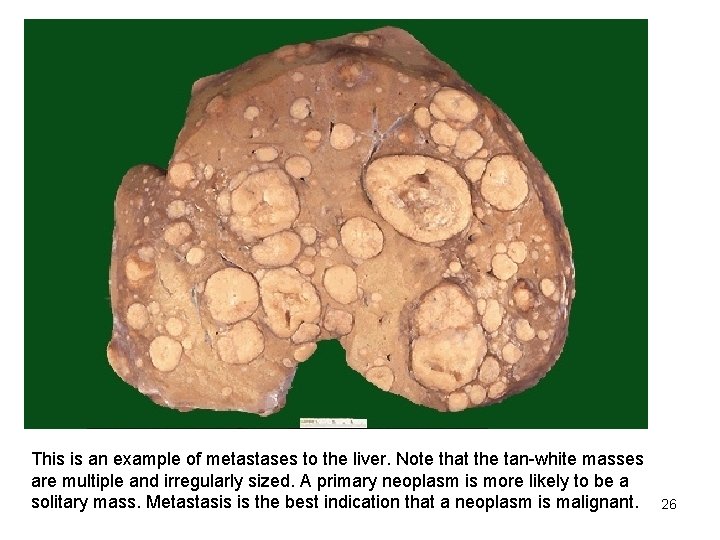 This is an example of metastases to the liver. Note that the tan-white masses