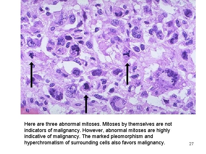 Here are three abnormal mitoses. Mitoses by themselves are not indicators of malignancy. However,