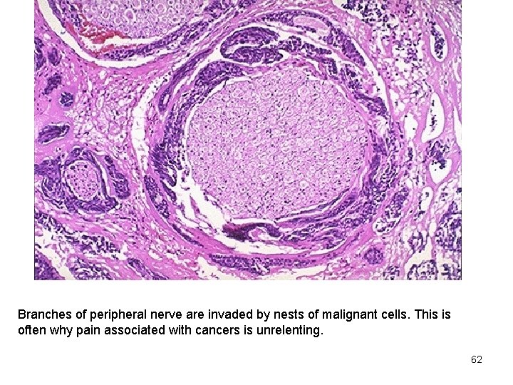 Branches of peripheral nerve are invaded by nests of malignant cells. This is often